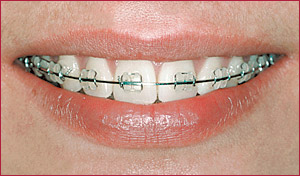 brackets053